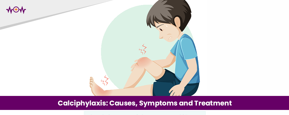 Calciphylaxis: Causes, Symptoms and Treatment